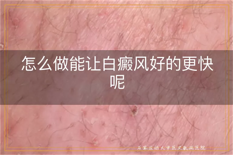 怎么做能让白癜风好的更快呢