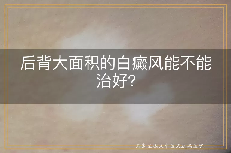 后背大面积的白癜风能不能治好？
