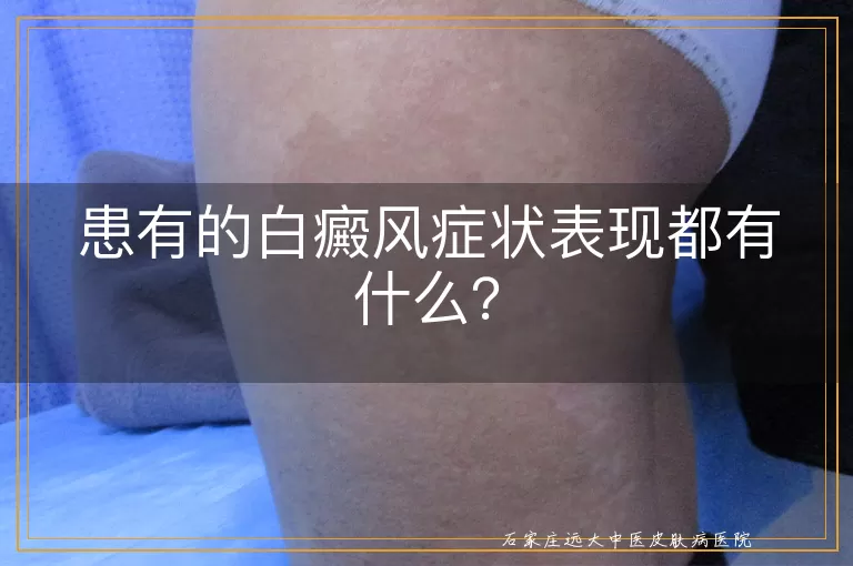 患有的白癜风症状表现都有什么？