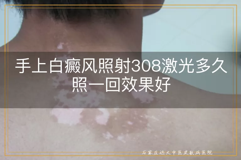 手上白癜风照射308激光多久照一回效果好