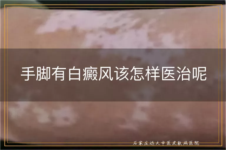 手脚有白癜风该怎样医治呢