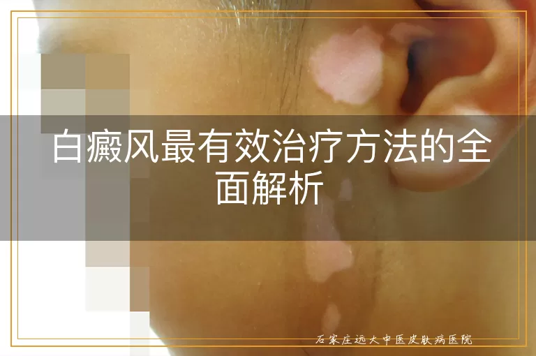 白癜风最有效治疗方法的全面解析