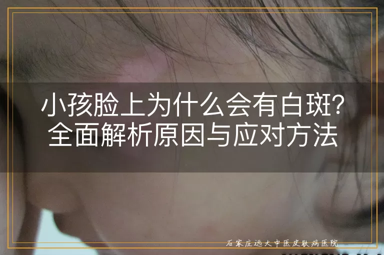 小孩脸上为什么会有白斑？全面解析原因与应对方法