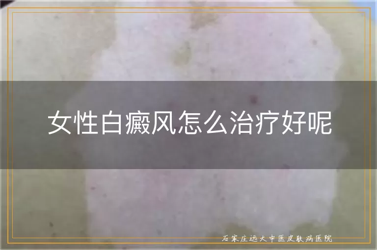 女性白癜风怎么治疗好呢