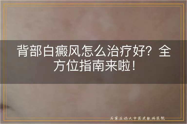 背部白癜风怎么治疗好？全方位指南来啦！