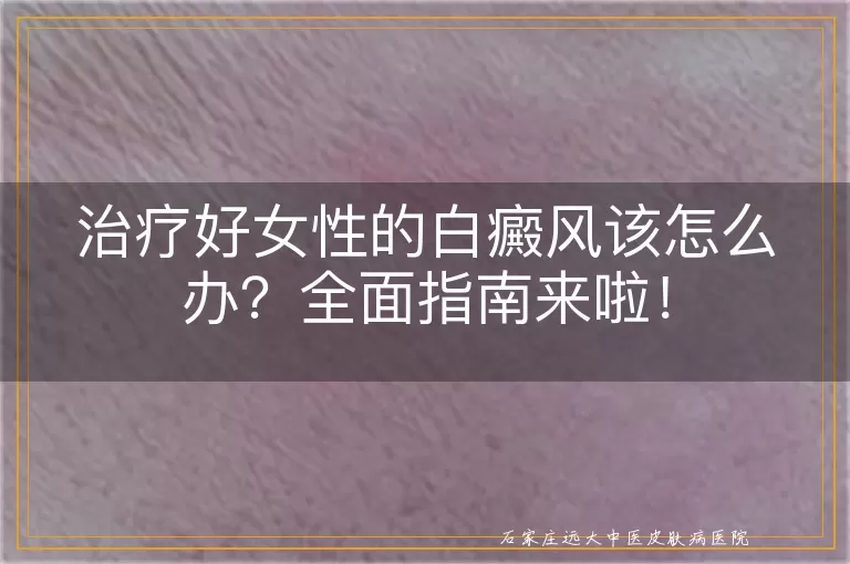 治疗好女性的白癜风该怎么办？全面指南来啦！