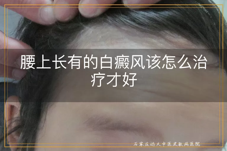 腰上长有的白癜风该怎么治疗才好