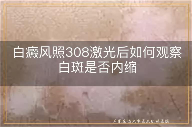 白癜风照308激光后如何观察白斑是否内缩
