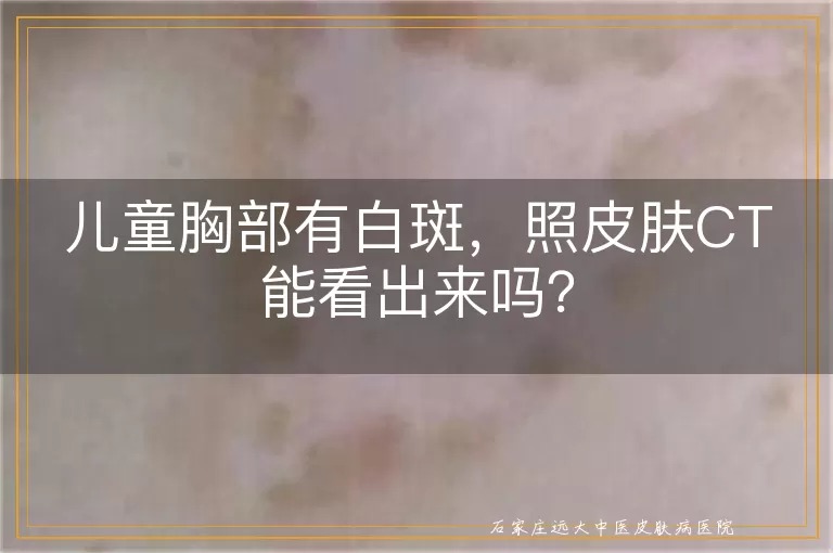 儿童胸部有白斑，照皮肤CT能看出来吗？