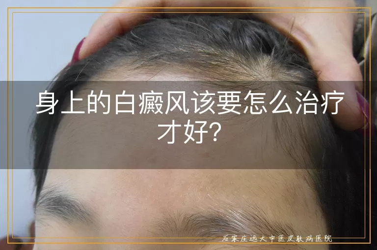 身上的白癜风该要怎么治疗才好？