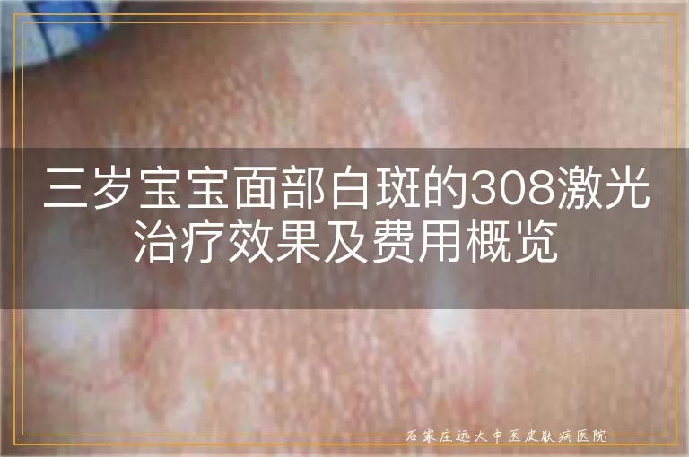 三岁宝宝面部白斑的308激光治疗效果及费用概览