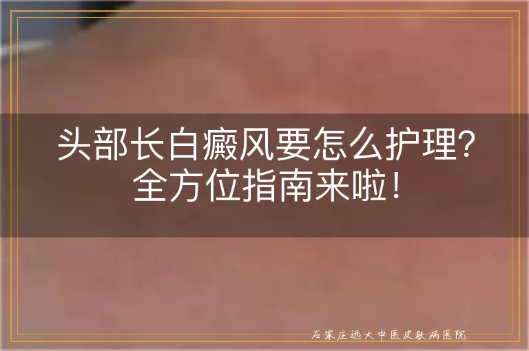 头部长白癜风要怎么护理？全方位指南来啦！