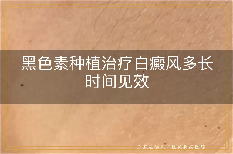 黑色素种植治疗白癜风多长时间见效