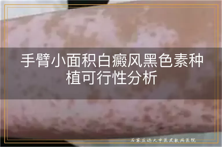 手臂小面积白癜风黑色素种植可行性分析