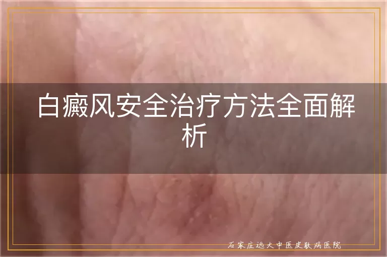 白癜风安全治疗方法全面解析