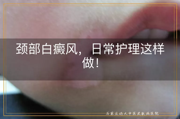 颈部白癜风，日常护理这样做！