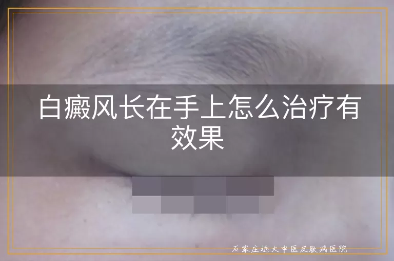 白癜风长在手上怎么治疗有效果