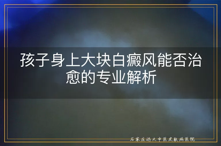 孩子身上大块白癜风能否治愈的专业解析