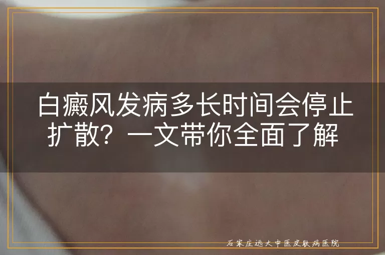 白癜风发病多长时间会停止扩散？一文带你全面了解
