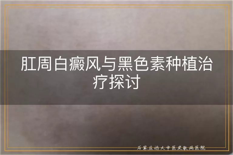 肛周白癜风与黑色素种植治疗探讨