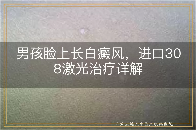 男孩脸上长白癜风，进口308激光治疗详解
