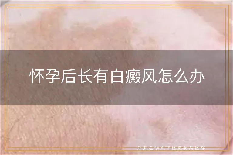 怀孕后长有白癜风怎么办
