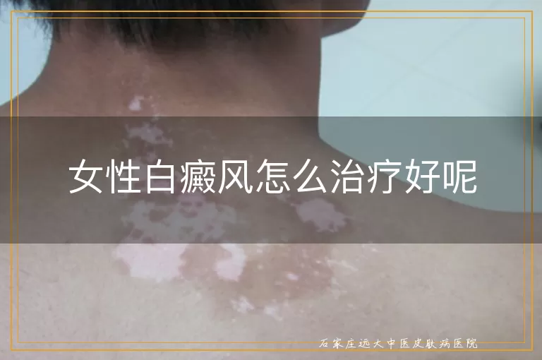 女性白癜风怎么治疗好呢