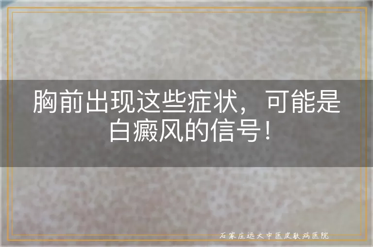 胸前出现这些症状，可能是白癜风的信号！