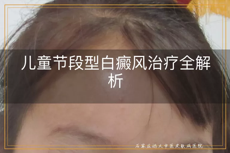 儿童节段型白癜风治疗全解析