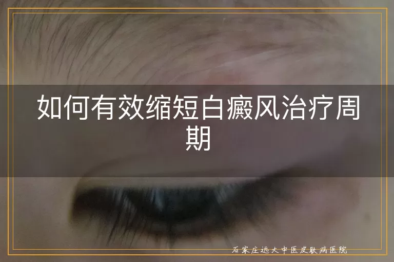 如何有效缩短白癜风治疗周期