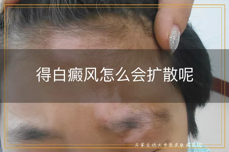 得白癜风怎么会扩散呢