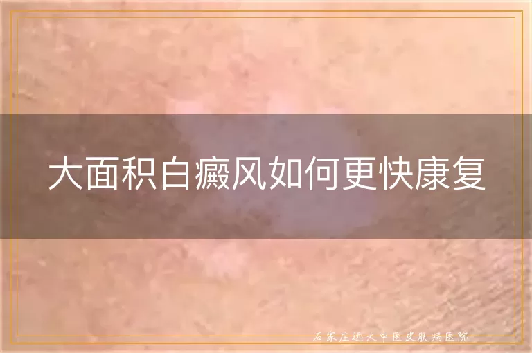 大面积白癜风如何更快康复