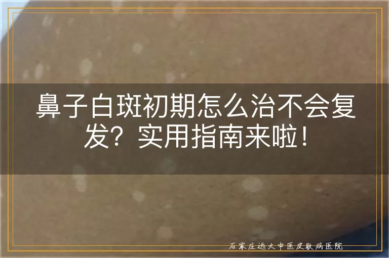 鼻子白斑初期怎么治不会复发？实用指南来啦！