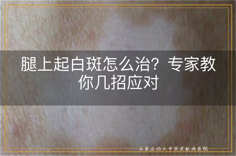 腿上起白斑怎么治？专家教你几招应对