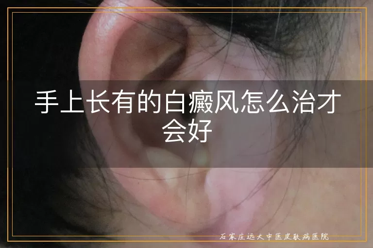手上长有的白癜风怎么治才会好