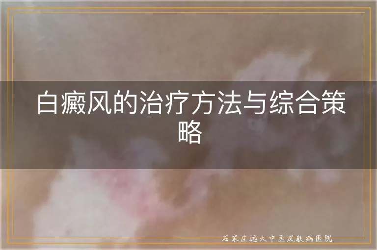 白癜风的治疗方法与综合策略