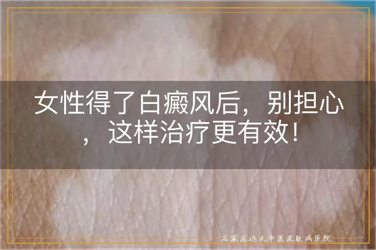 女性得了白癜风后，别担心，这样治疗更有效！