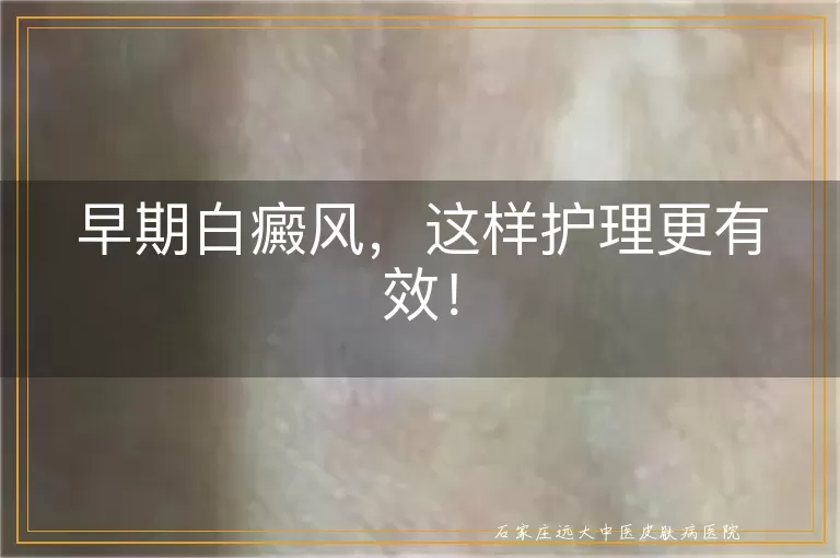 早期白癜风，这样护理更有效！