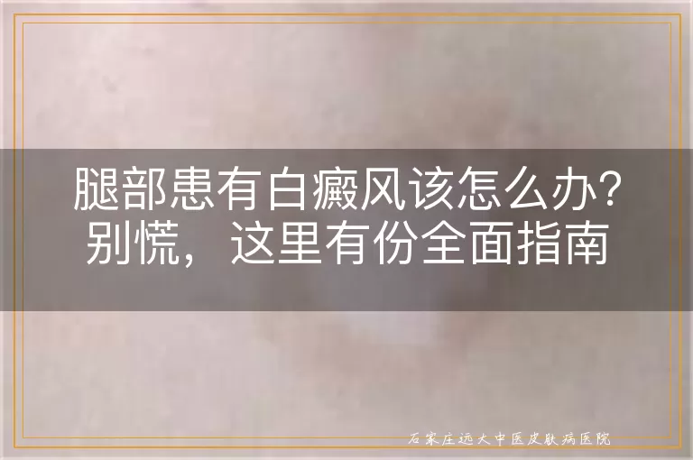腿部患有白癜风该怎么办？别慌，这里有份全面指南