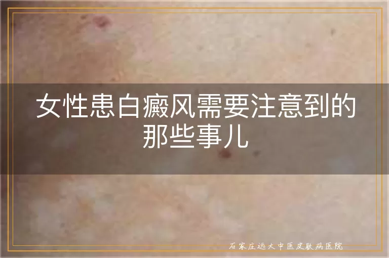 女性患白癜风需要注意到的那些事儿