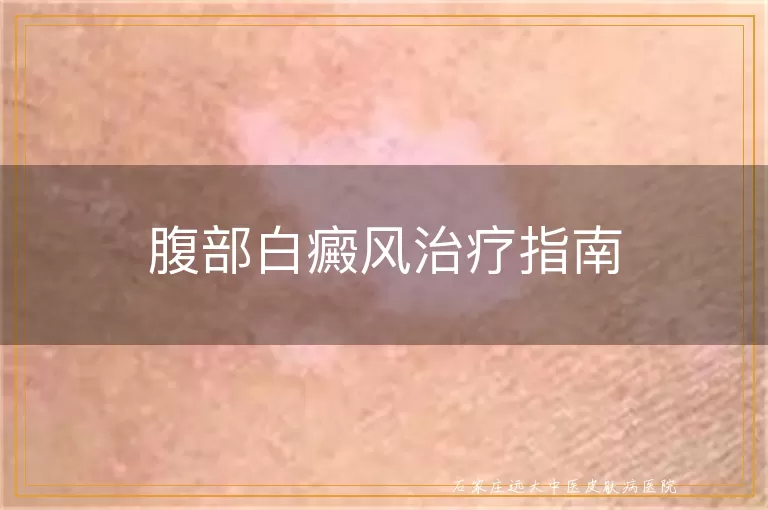 腹部白癜风治疗指南
