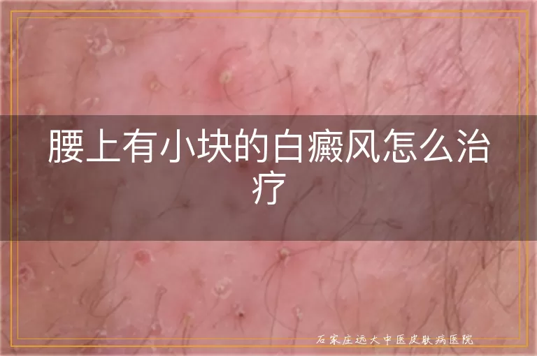 腰上有小块的白癜风怎么治疗