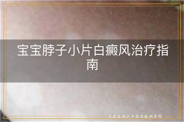 宝宝脖子小片白癜风治疗指南