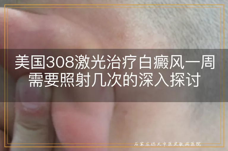 美国308激光治疗白癜风一周需要照射几次的深入探讨