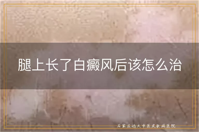 腿上长了白癜风后该怎么治