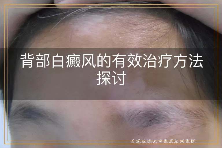 背部白癜风的有效治疗方法探讨