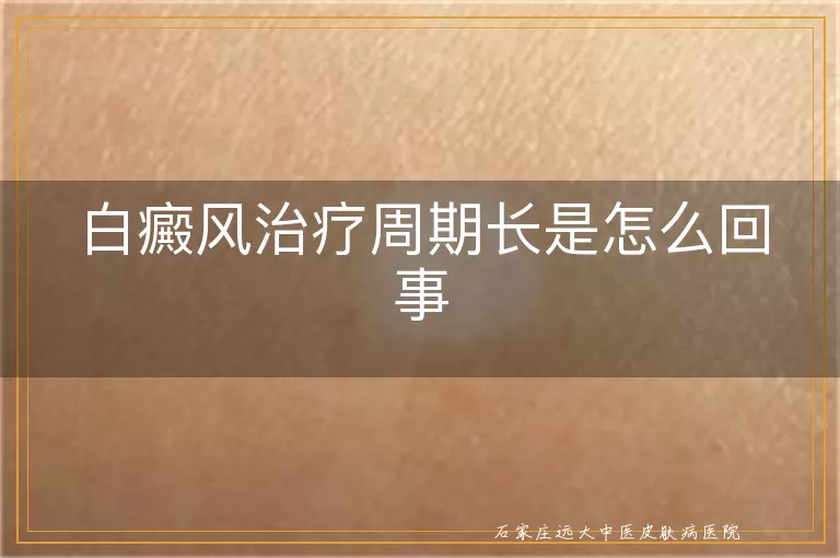 白癜风治疗周期长是怎么回事