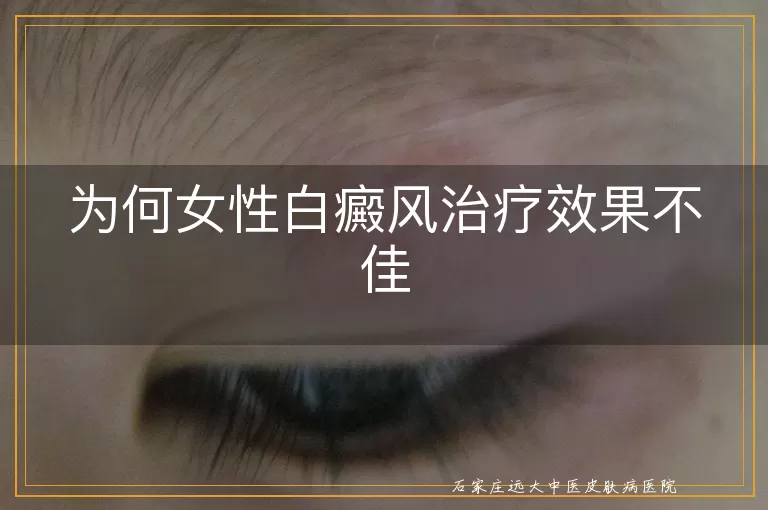 为何女性白癜风治疗效果不佳