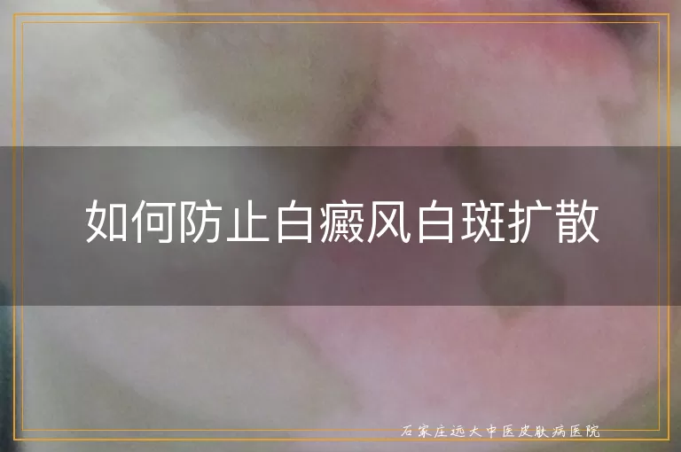 如何防止白癜风白斑扩散