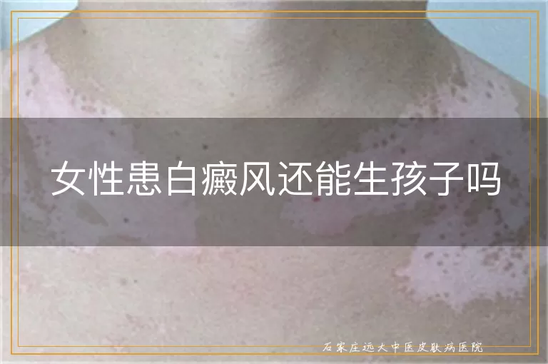 女性患白癜风还能生孩子吗